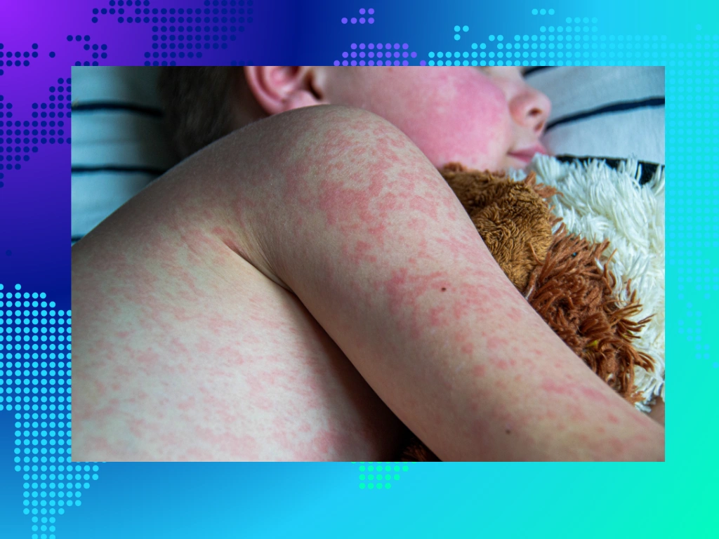 measles